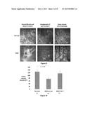 MEIBOMIAN GLAND DYSFUNCTION diagram and image