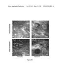 MEIBOMIAN GLAND DYSFUNCTION diagram and image