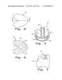 DRUG DELIVERY IMPLANTS diagram and image