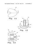 DRUG DELIVERY IMPLANTS diagram and image