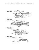 METHODS AND DEVICES FOR REPAIRING AND ANCHORING DAMAGED TISSUE diagram and image