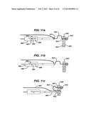 METHODS AND DEVICES FOR REPAIRING AND ANCHORING DAMAGED TISSUE diagram and image