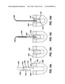 METHODS AND DEVICES FOR REPAIRING AND ANCHORING DAMAGED TISSUE diagram and image