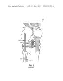 ADJUSTABLE GRAFT FIXATION DEVICE diagram and image