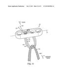 ADJUSTABLE GRAFT FIXATION DEVICE diagram and image