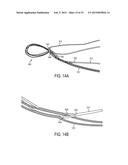 ADJUSTABLE GRAFT FIXATION DEVICE diagram and image