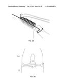 TRANSOSTEAL ANCHORING METHODS FOR TISSUE REPAIR diagram and image