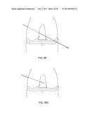 TRANSOSTEAL ANCHORING METHODS FOR TISSUE REPAIR diagram and image