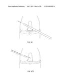 TRANSOSTEAL ANCHORING METHODS FOR TISSUE REPAIR diagram and image