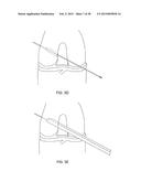 TRANSOSTEAL ANCHORING METHODS FOR TISSUE REPAIR diagram and image