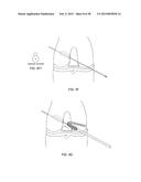 TRANSOSTEAL ANCHORING METHODS FOR TISSUE REPAIR diagram and image