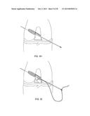 TRANSOSTEAL ANCHORING METHODS FOR TISSUE REPAIR diagram and image