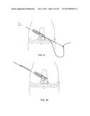 TRANSOSTEAL ANCHORING METHODS FOR TISSUE REPAIR diagram and image