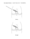 TRANSOSTEAL ANCHORING METHODS FOR TISSUE REPAIR diagram and image