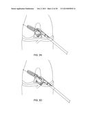 TRANSOSTEAL ANCHORING METHODS FOR TISSUE REPAIR diagram and image