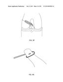 TRANSOSTEAL ANCHORING METHODS FOR TISSUE REPAIR diagram and image