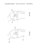 TRANSOSTEAL ANCHORING METHODS FOR TISSUE REPAIR diagram and image