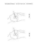 TRANSOSTEAL ANCHORING METHODS FOR TISSUE REPAIR diagram and image