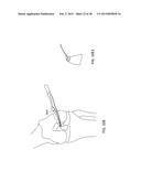 TRANSOSTEAL ANCHORING METHODS FOR TISSUE REPAIR diagram and image