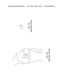 TRANSOSTEAL ANCHORING METHODS FOR TISSUE REPAIR diagram and image