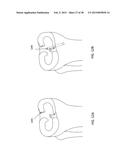 TRANSOSTEAL ANCHORING METHODS FOR TISSUE REPAIR diagram and image