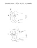 TRANSOSTEAL ANCHORING METHODS FOR TISSUE REPAIR diagram and image