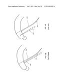 TRANSOSTEAL ANCHORING METHODS FOR TISSUE REPAIR diagram and image