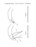 TRANSOSTEAL ANCHORING METHODS FOR TISSUE REPAIR diagram and image