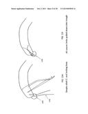 TRANSOSTEAL ANCHORING METHODS FOR TISSUE REPAIR diagram and image