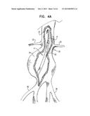 VASCULAR PROSTHESIS FOR TREATING ANEURYSMS diagram and image