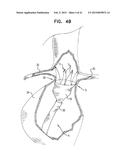 VASCULAR PROSTHESIS FOR TREATING ANEURYSMS diagram and image