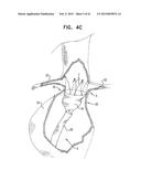 VASCULAR PROSTHESIS FOR TREATING ANEURYSMS diagram and image