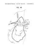 VASCULAR PROSTHESIS FOR TREATING ANEURYSMS diagram and image