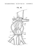 VASCULAR PROSTHESIS FOR TREATING ANEURYSMS diagram and image