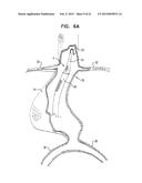 VASCULAR PROSTHESIS FOR TREATING ANEURYSMS diagram and image