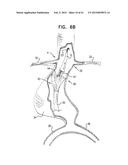 VASCULAR PROSTHESIS FOR TREATING ANEURYSMS diagram and image