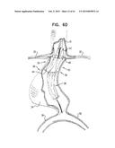 VASCULAR PROSTHESIS FOR TREATING ANEURYSMS diagram and image