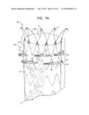 VASCULAR PROSTHESIS FOR TREATING ANEURYSMS diagram and image