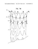 VASCULAR PROSTHESIS FOR TREATING ANEURYSMS diagram and image