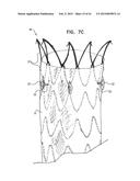 VASCULAR PROSTHESIS FOR TREATING ANEURYSMS diagram and image