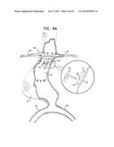 VASCULAR PROSTHESIS FOR TREATING ANEURYSMS diagram and image