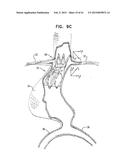 VASCULAR PROSTHESIS FOR TREATING ANEURYSMS diagram and image