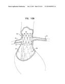 VASCULAR PROSTHESIS FOR TREATING ANEURYSMS diagram and image