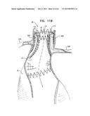 VASCULAR PROSTHESIS FOR TREATING ANEURYSMS diagram and image