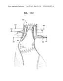 VASCULAR PROSTHESIS FOR TREATING ANEURYSMS diagram and image