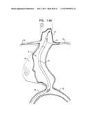 VASCULAR PROSTHESIS FOR TREATING ANEURYSMS diagram and image
