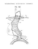 VASCULAR PROSTHESIS FOR TREATING ANEURYSMS diagram and image