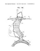 VASCULAR PROSTHESIS FOR TREATING ANEURYSMS diagram and image