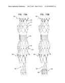 VASCULAR PROSTHESIS FOR TREATING ANEURYSMS diagram and image