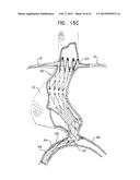 VASCULAR PROSTHESIS FOR TREATING ANEURYSMS diagram and image